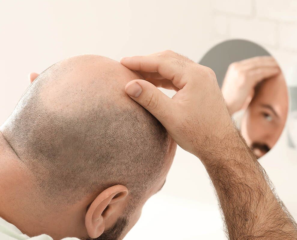 Hair Transplant London (Ontario) | The Toronto Hair Transplant Clinic